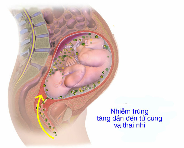 Nguy cơ và biến chứng của màng ối rụng sớm